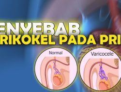 Pentingnya Memahami Varikokel dan Kesuburan Pria
